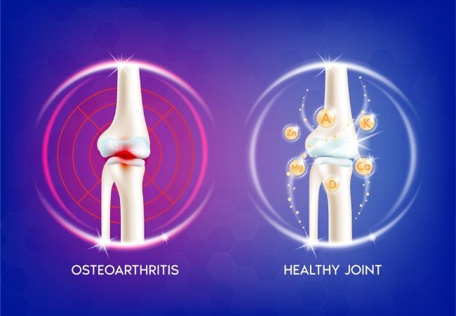 osteoporosis-symptoms-diagnosis-and-treatment