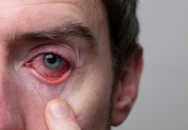 Common Eye Diseases