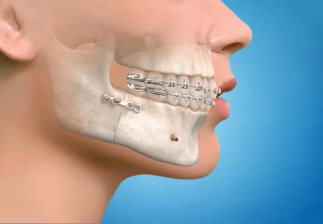 Maxillofacial Surgery: What It Is and When You Might Need It